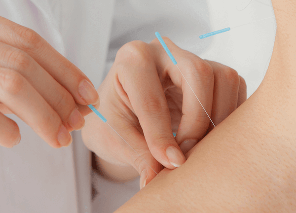 Akupunktur
